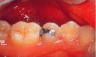 An amalgam filling in a lower pre molar. The filling is starting to fail.