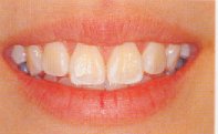 Prior to tooth contouring - incisors look angular and rather masculine.