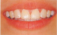 After tooth contouring - incisors look softer and more feminine.