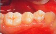 The amalgam filling has been replaced by a tooth coloured "composite" filling.