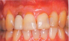 Discoloured upper front teeth with old fillings and crowns