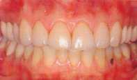 After placing veneers on six upper front teeth