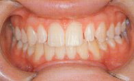 This patient has mishapen upper lateral incisors 