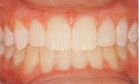 Veneers used to improve shape and appearance of upper lateral incisors. 